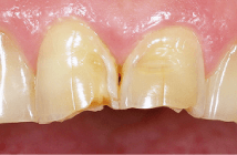 歯の破断