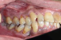 歯軋りによる歯頚部の楔状欠損