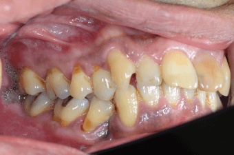 歯軋りによる歯頚部の楔状欠損