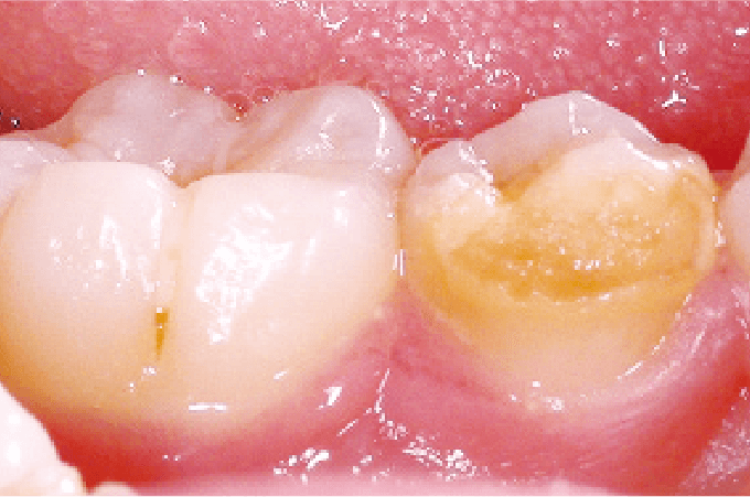 乳歯のむし歯は永久歯に悪影響を与えます