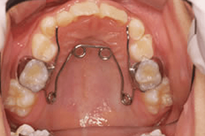 お子様の歯の状態に合わせた矯正装置をご提案します