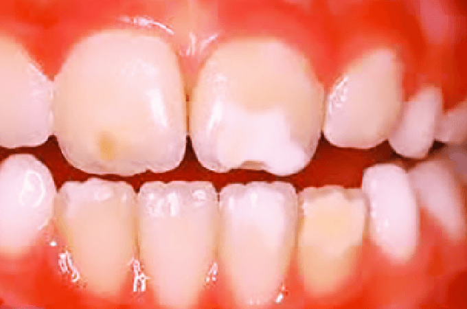 乳歯の感染源を放置することによって、永久歯にダメージが発生してしまいます