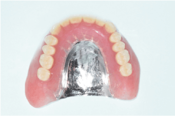 義歯のイメージ