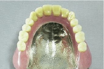 金属床義歯（チタン）イメージ