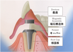磁石式アタッチメント義歯イメージ