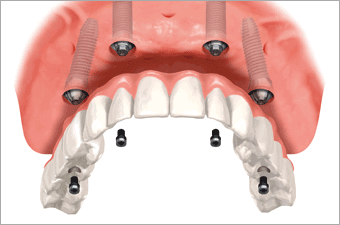 入れ歯が粘膜に沈み込まず支えがある入れ歯