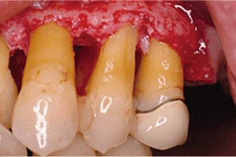 歯周外科手術（再生療法）のイメージ