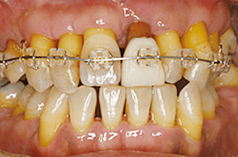 歯周矯正のイメージ