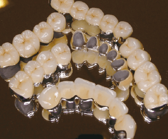 歯周補綴イメージ
