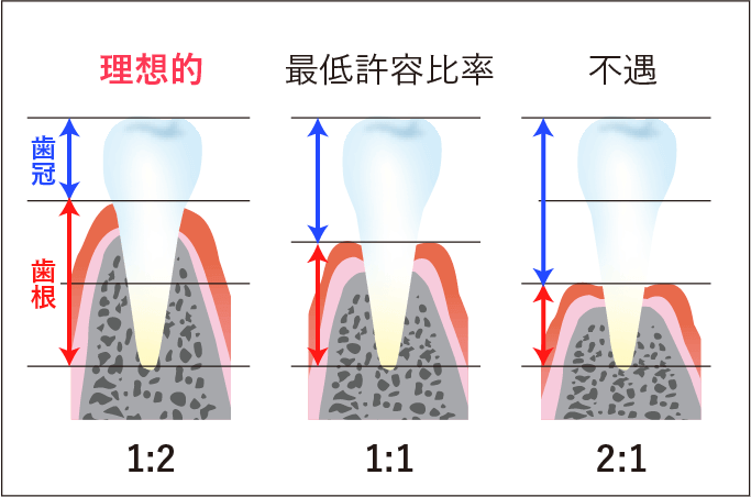 動揺している歯の長期予後は非常に悪く、そのままにしていると歯の寿命が短くなってしまいます。