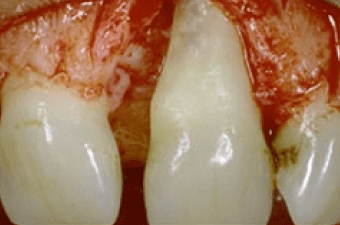 歯周外科手術による歯肉弁の作成のイメージ