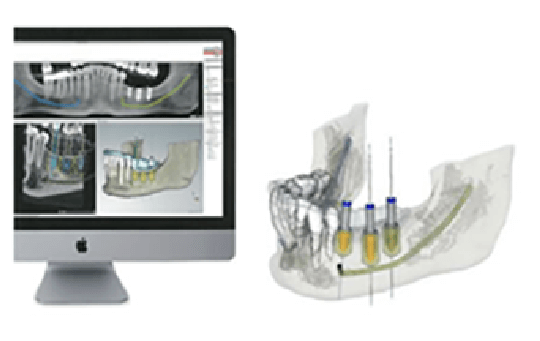 歯科用CTでのシミュレーション