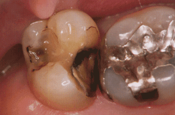 修復材料周囲に発生する2次的虫歯のケース