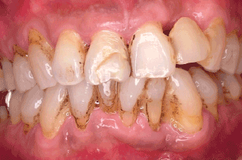歯周病の事例