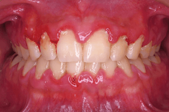 歯周病の事例