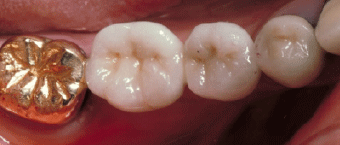 軽度のむし歯：C3 の治療例