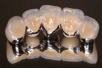 進行しすぎたむし歯：C4の治療例