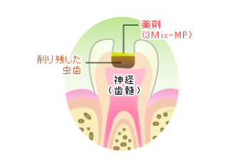 3MIX-MP法の例