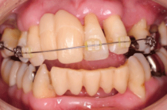 歯周病矯正の事例