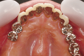 動揺した歯を裏側から連結した事例