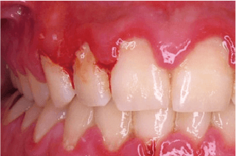 歯周病のケース