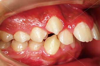 治療前の歯並びイメージ