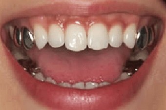 治療前の銀歯イメージ