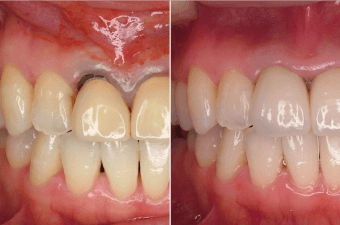 歯茎の黒ずみを解消する治療<イメージ