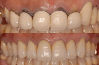 歯茎の形を整える治療イメージ