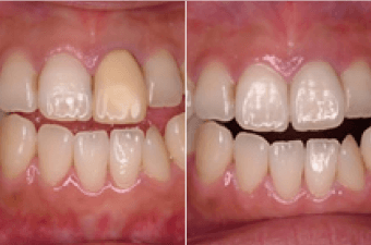 差し歯部分の歯茎の黒ずみを解消する治療イメージ