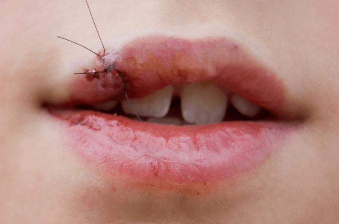 お口の怪我の事例