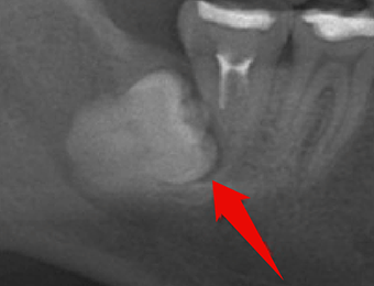 難抜歯の事例