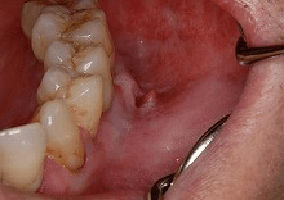 潰瘍タイプの歯肉癌の事例