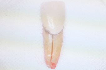 抜歯した歯のイメージ