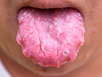 舌の病気
